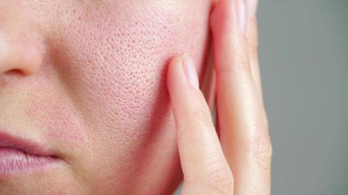 Why Are My Pores Large? Skincare Secrets to Make Them Smaller!