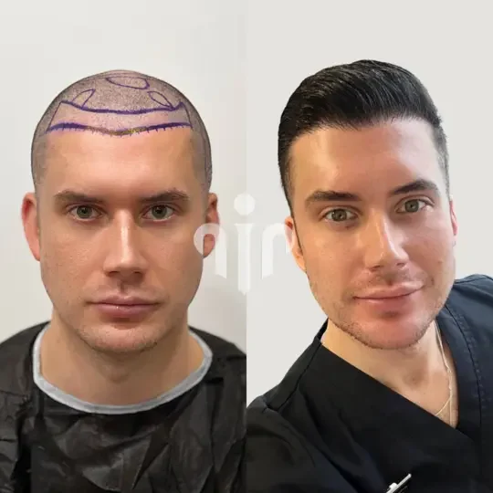 Honest Reviews of Hair Center of Turkey: Expert Opinions and Patient Experiences