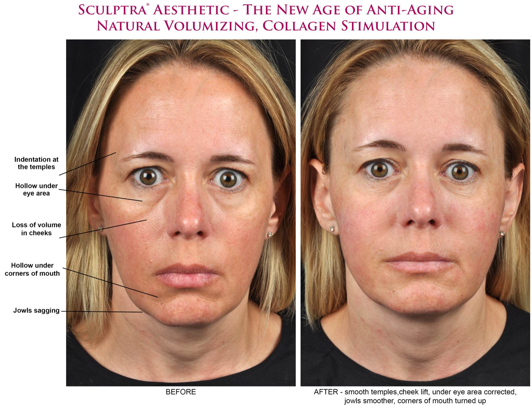 Sculptra Before & After: See Real Patients Sculptra Review!