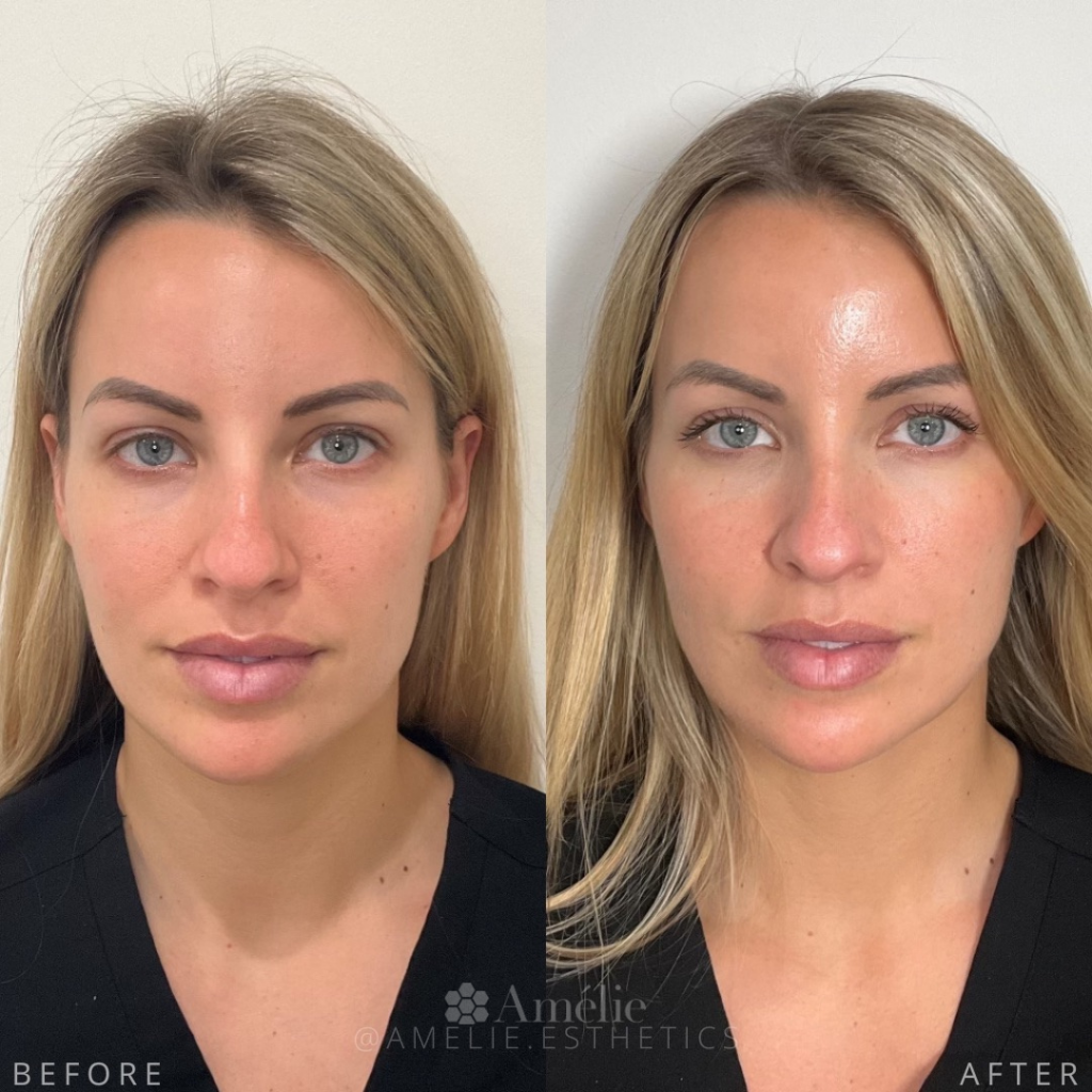 Sculptra Before & After: See Real Patients Sculptra Review!