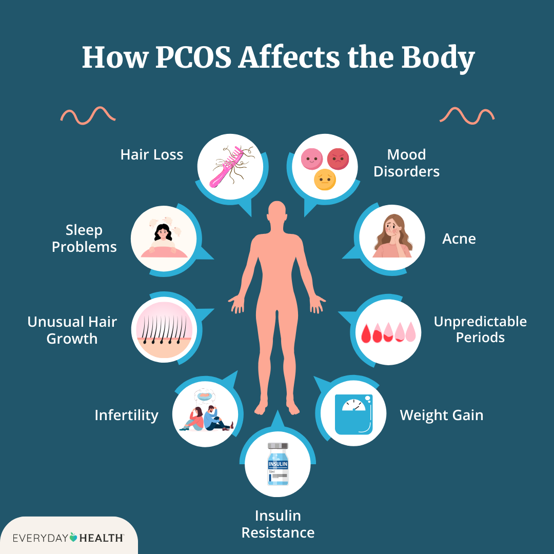 Experiencing PCOS Storm Shock? Find Out What Triggers It.